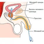 After surgery for hydronephrosis