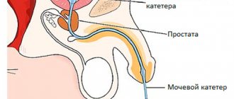 After surgery for hydronephrosis