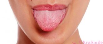 Superficial glossitis of the tongue