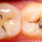 black spots appeared on teeth