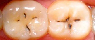 black spots appeared on teeth