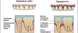 The drug is prescribed for inflammatory pathologies of the oral cavity