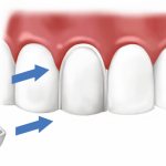 Application of veneers