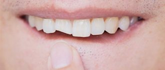 Signs of a fracture - Smile Line Dentistry