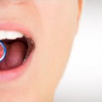 Probiotics for restoring oral microflora and treating tissue inflammation