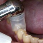 The process of treating a tooth with ozone