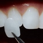 Процесс восстановления зуба установкой композитного винира
