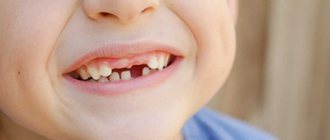 Eruption of molars in children