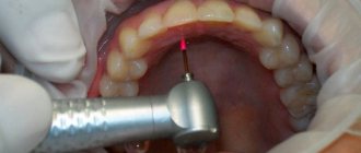 laser coagulation of gums