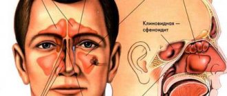 Manifestations of sinusitis (inflammation of the paranasal sinuses).jpg