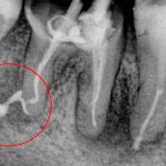 Pulpitis toothache