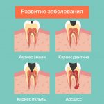 Development of pulpitis in pictures