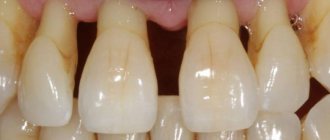Gum recession due to periodontitis