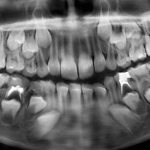 X-ray of baby teeth