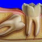 Retracted tooth