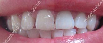 Result of whitening with toothpaste