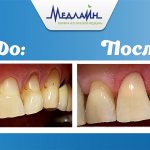 The result of dental restoration at the MedLine clinic