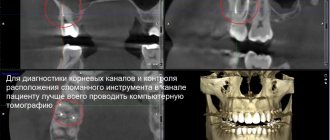 ри проведении первичной диагностики КЛКТ мы выявили факт расположения сломанного инструмента в корневом канале