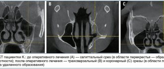 Рис. 1. КЛКТ пациентки К.: до оперативного лечения (А) — сагиттальный срез (в области перекрестья — образование костной плотности); после оперативного лечения — трансверзальный (В) и коронарный (С) срезы (в области перекрестья — зона удаленного образовани