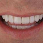 Seven main violations when creating a smile design