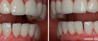 gaps between teeth