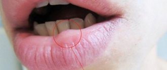 lump on lip