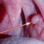 Lump on the roof of the mouth: causes