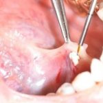 Sialendoscopy as a method for removing stones from the salivary gland