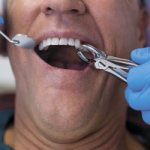 How long does anesthesia wear off after tooth extraction - Line of Smile Dentistry