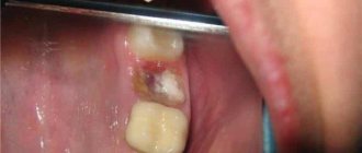 A tooth has broken at the root - what to do?