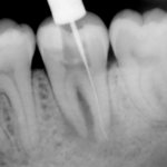 Photo of teeth at the treatment stage