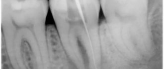 Photo of teeth at the treatment stage