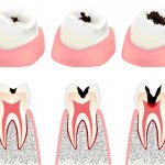 Stages of caries