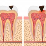 Stages of caries