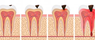 Stages of caries