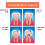 Стадии развития кариеса в картинках