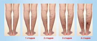 Stages of development of ulcers with varicose veins