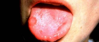 Stomatitis in a child