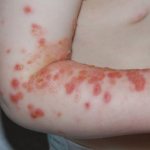 streptoderma complications