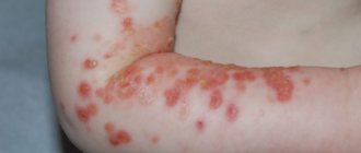 streptoderma complications