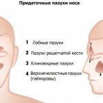 Subtotal darkening of the maxillary sinuses. What is it, how to treat with and without liquid, horizontal, vertical level 