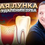 Сухая лунка - синдром после удаления зуба мудрости