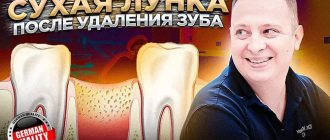 Сухая лунка - синдром после удаления зуба мудрости