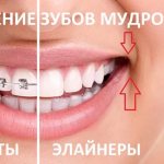 Removal of wisdom teeth to correct bite