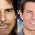 Tom Cruise smile, teeth fixed with braces