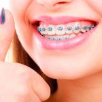 Installation of braces PHOTO