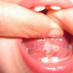 Tongue frenulum in a child after laser surgery