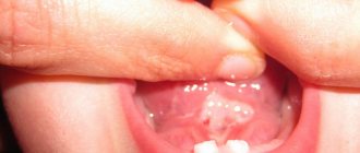 Tongue frenulum in a child after laser surgery