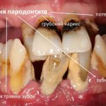 First of all, a serious occlusal injury, which you can observe in the form of teeth literally scattered at different angles