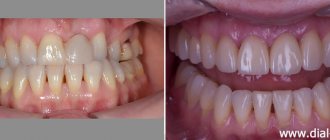 view of teeth before and after complex treatment with implantation and prosthetics
